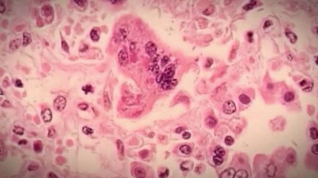 measles-generic.jpg